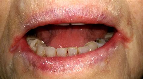 queilitis angular|Angular cheilitis